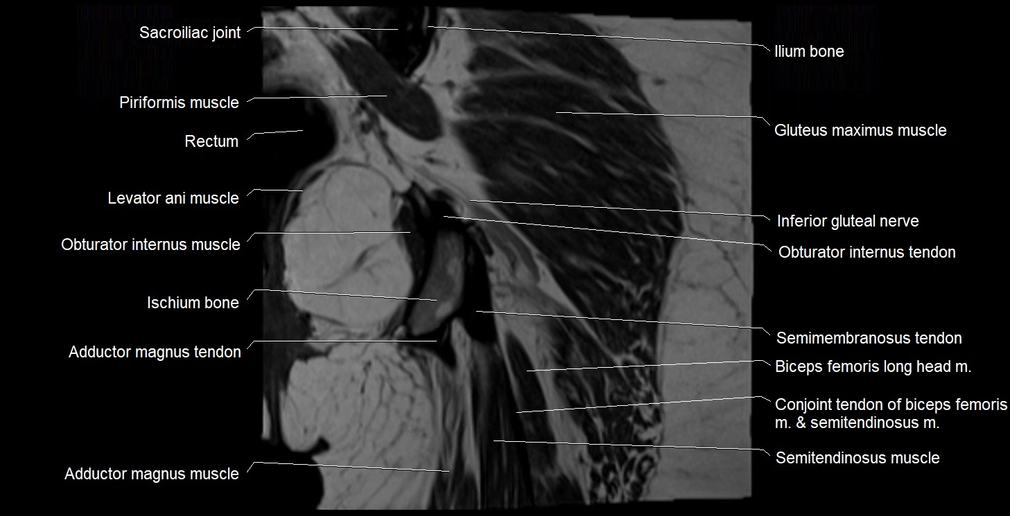 MRI Hip 3T coronal cross sectional anatomy image 53.webp